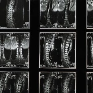 Care of Spinal Injury Policy (Care Homes) £27